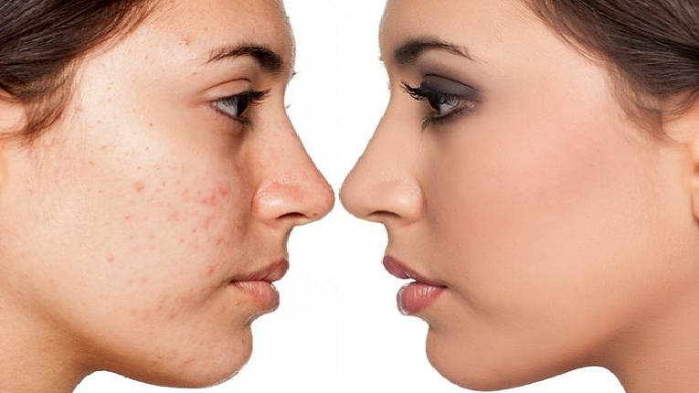 শীতে ব্রণের সমস্যা থেকে রেহাই পেতে যা করবেন